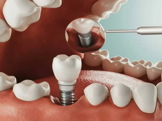 Trồng răng implant sử dụng được bao lâu thì cần làm lại