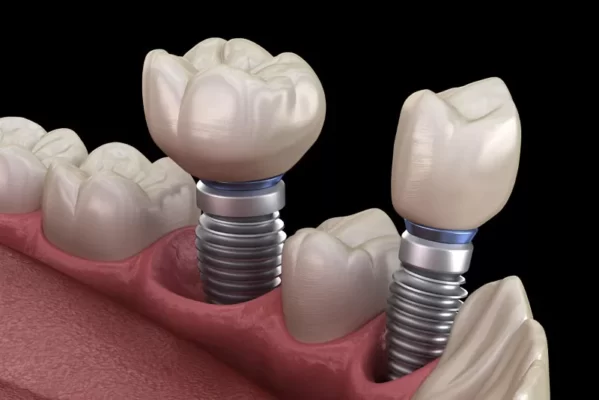 trồng răng Implant không có nguy hiểm không