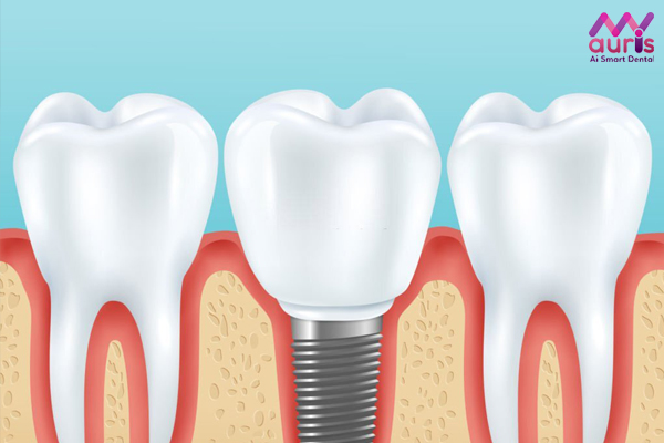 trồng răng implant có tốt không