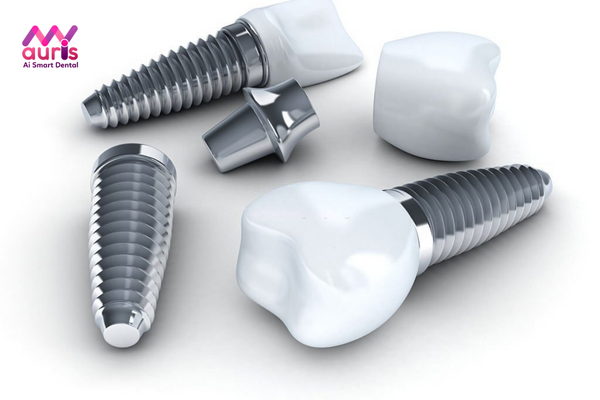 Lựa chọn trụ răng Implant