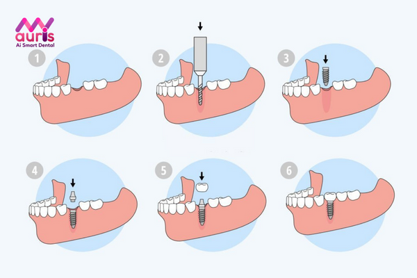 Giải đáp có nên trồng răng Implant không?