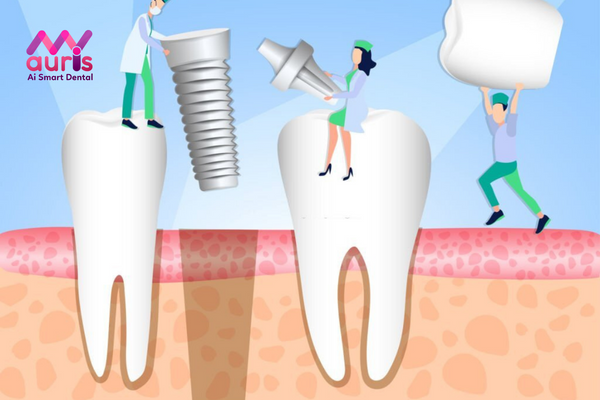 tác dụng phụ của trồng răng implant