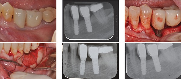 biến chứng khi trồng răng implant