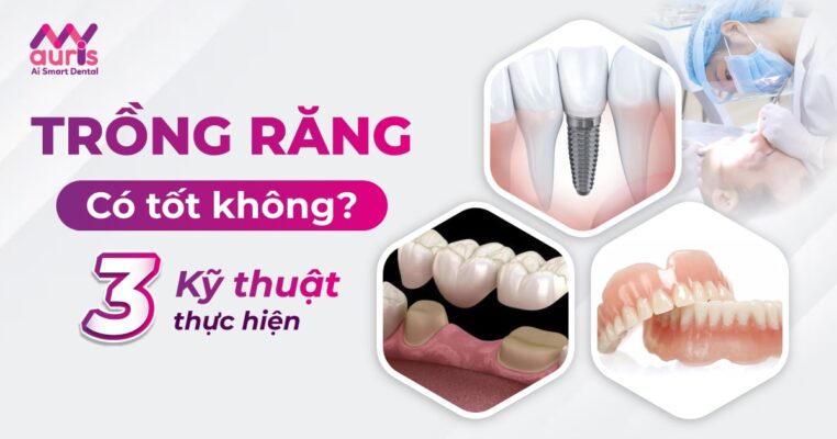 trồng răng có tốt không